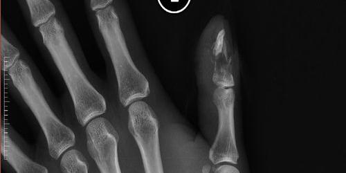 工伤轻微骨折一共赔多少万2021年？（轻微骨折赔1万五合理吗）