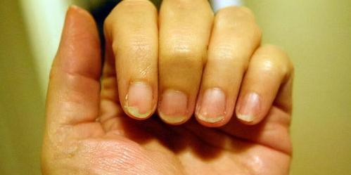 膏药粘在真皮沙发上怎么办？ 二氯甲烷弄到手上怎么办