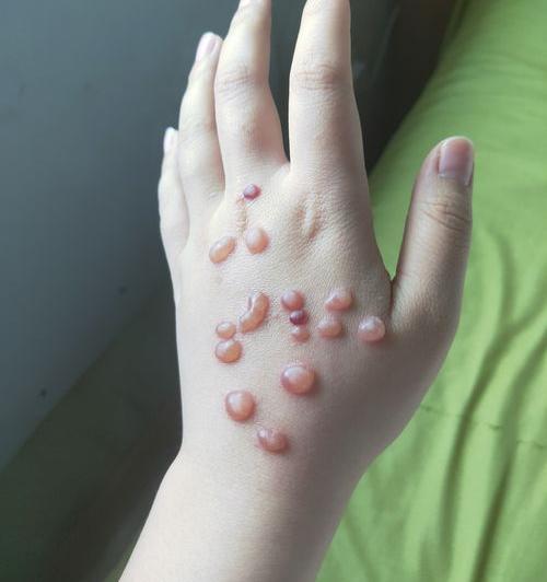 跖疣冷冻几次能除根？ 液氮冷冻治疗疣后多久会脱落