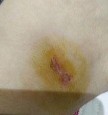 红霉素加蜂蜜摸脸可以祛斑吗 红霉素加一物一周就可以祛斑