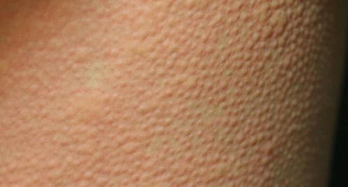 胆碱能性荨麻疹能根治吗 胆碱能性荨麻疹绝望了