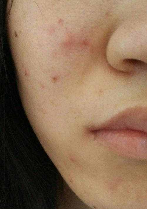 涂了阿帕达如何保湿？ 阿达帕林脱皮是好事吗