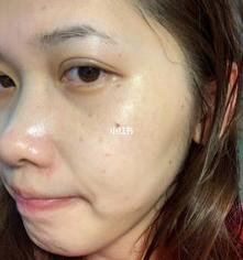 复方熊果苷乳膏会使色素颜色加深吗？ 熊果苷乳膏的正确使用方法